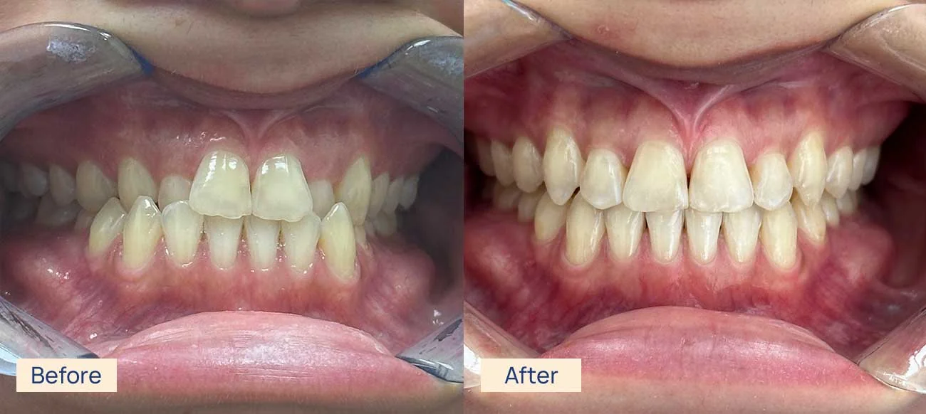 Invisalign crossbite before and after Waterloo