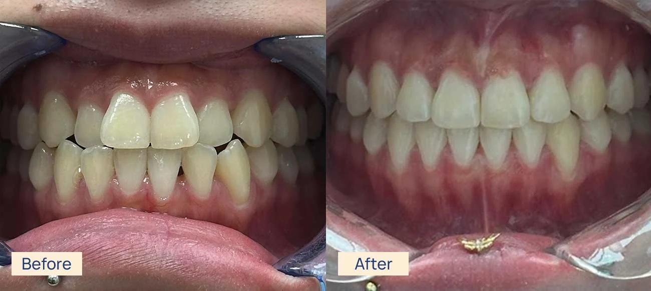 Invisalign crossbite correction before and after Waterloo