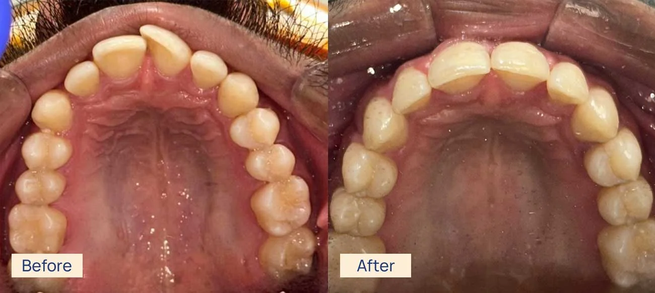 Invisalign crowding correction before and after Waterloo