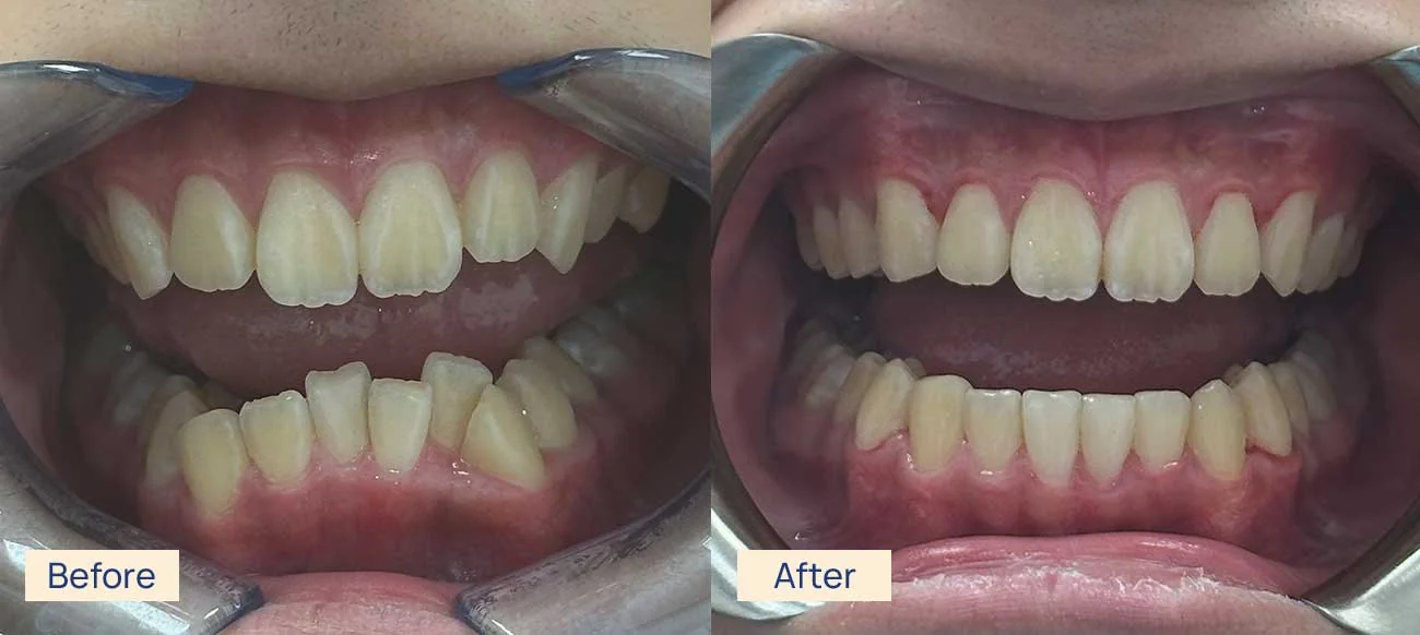 Invisalign crowding before and after Waterloo
