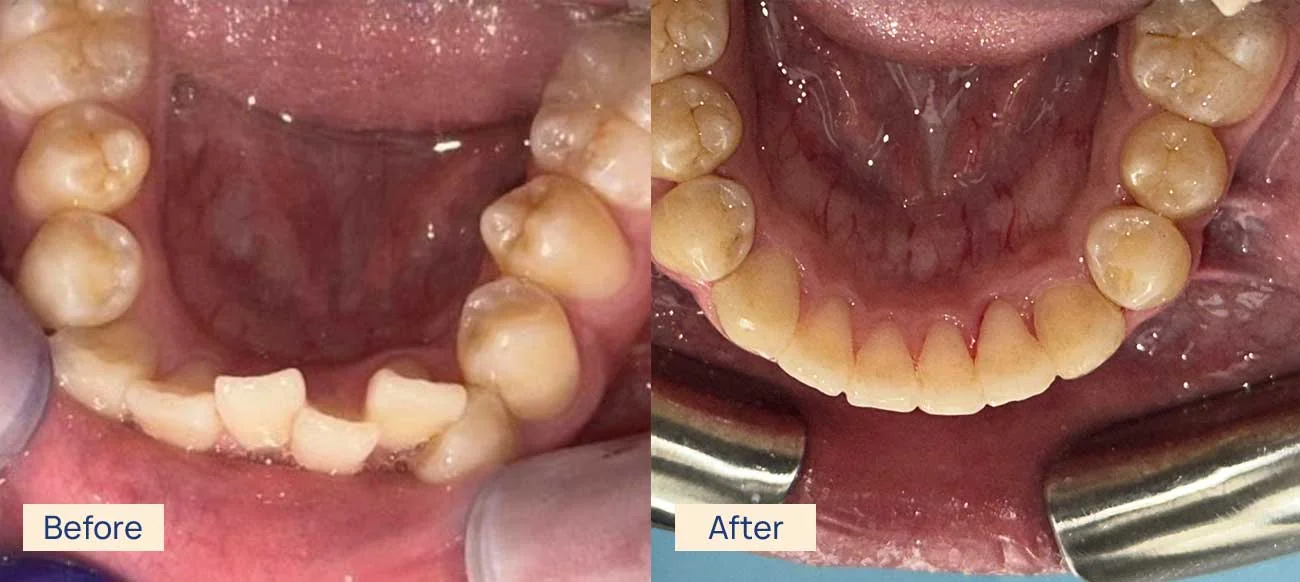 Invisalign crowded teeth before and after Waterloo