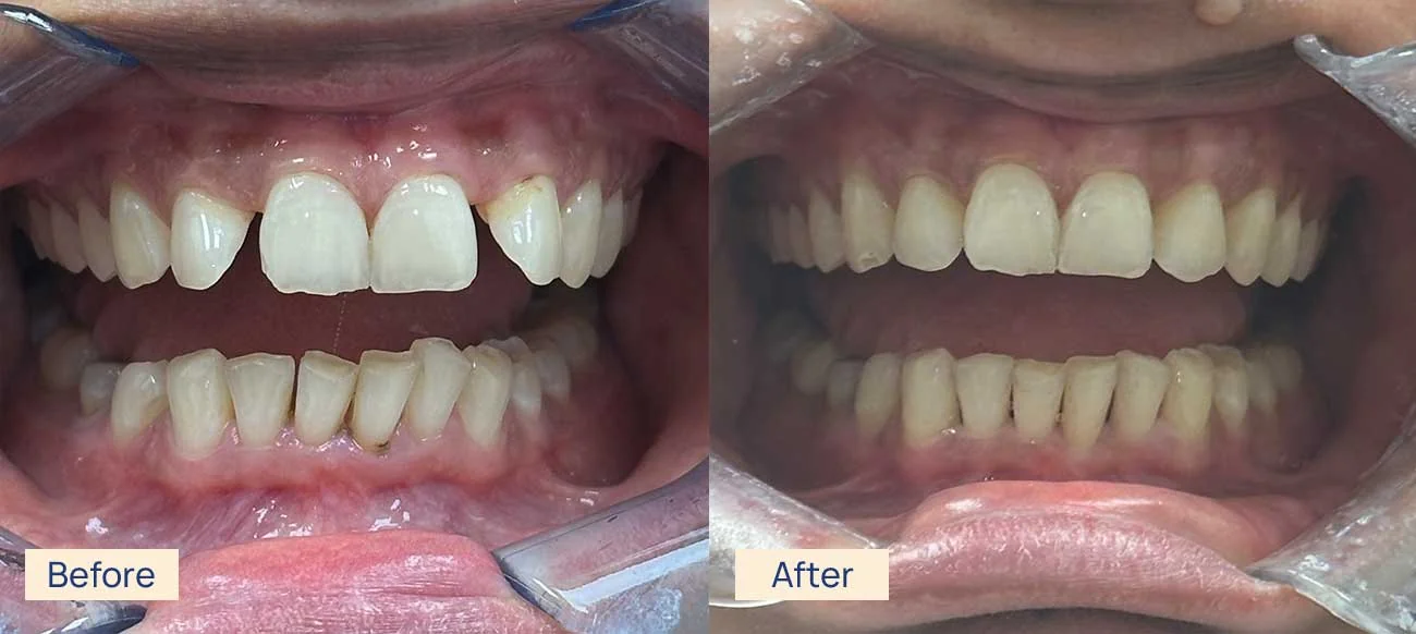 Invisalign rotated teeth before and after Waterloo