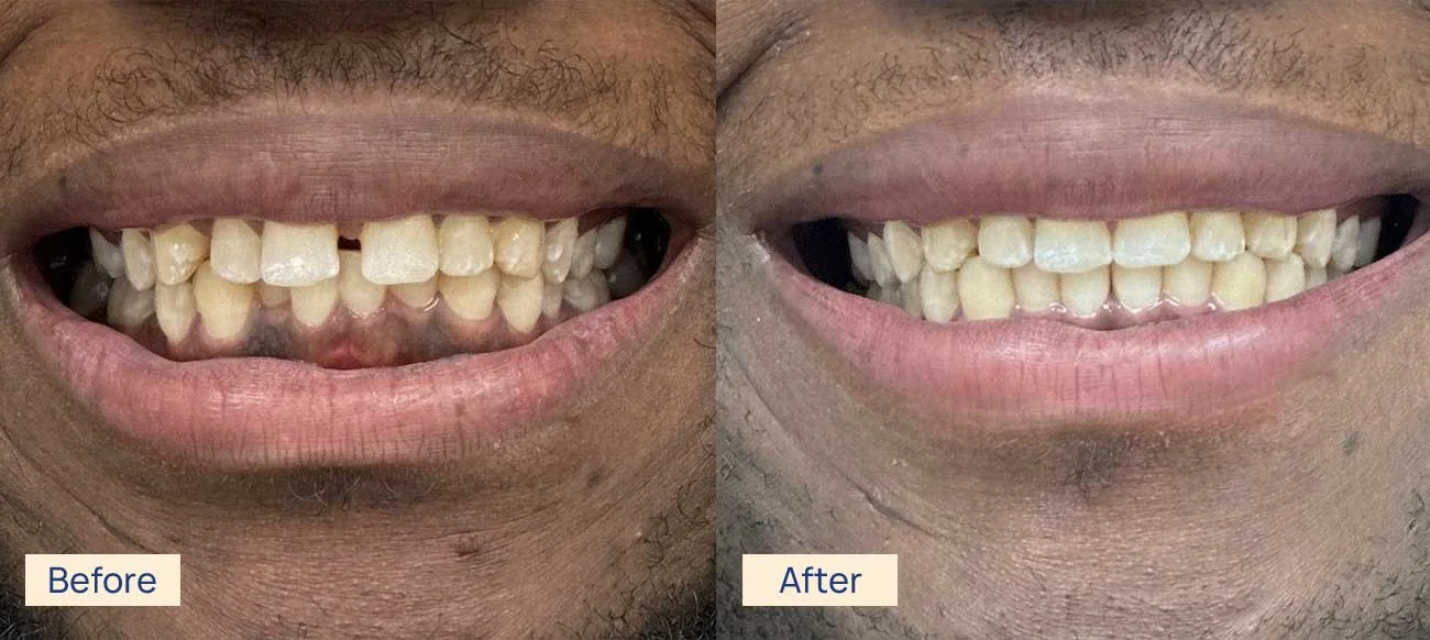 Invisalign smile transformation before and after Waterloo