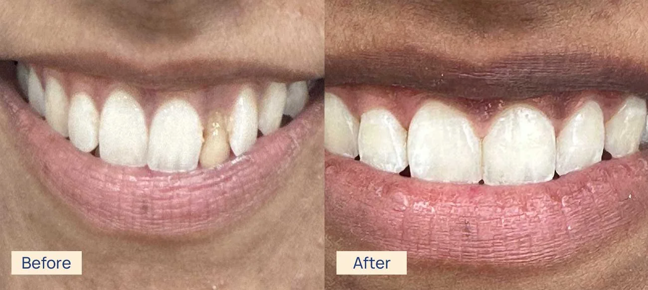 Invisalign smile result before and after Waterloo