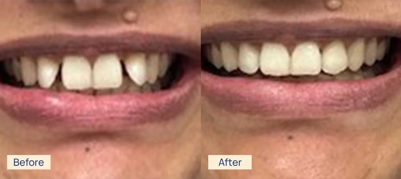 Invisalign teeth straightening before and after Waterloo