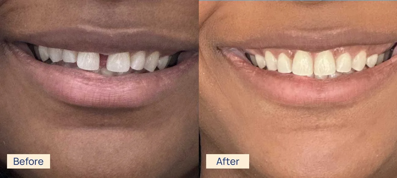 Invisalign smile improvement before and after Waterloo