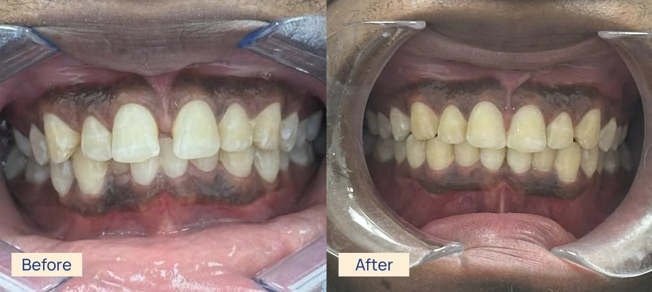 Invisalign spacing correction before and after Waterloo