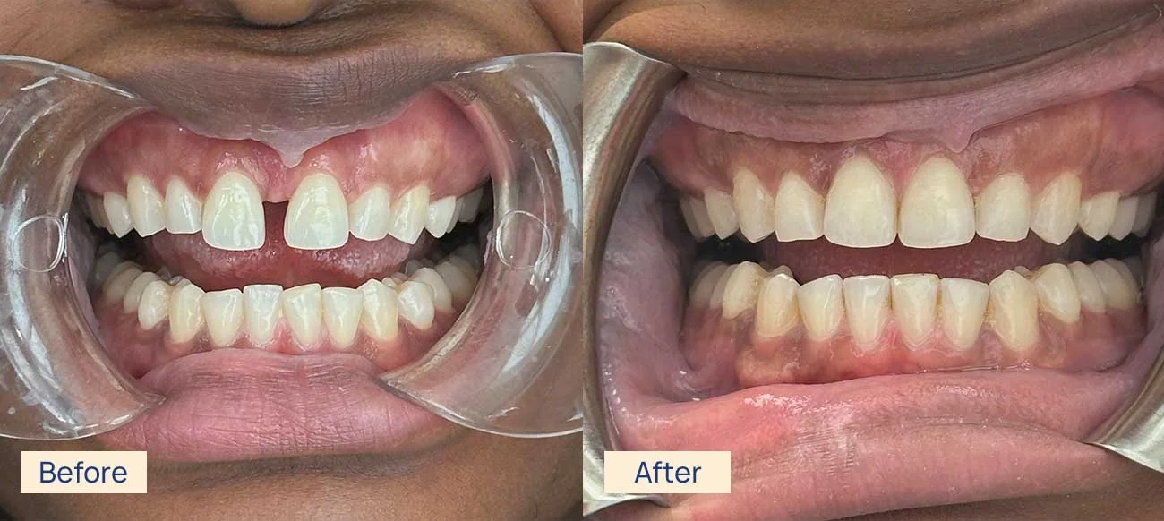 Invisalign spacing before and after Waterloo