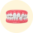 Invisalign treatment for crossbite