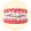 Invisalign treatment for crowded teeth