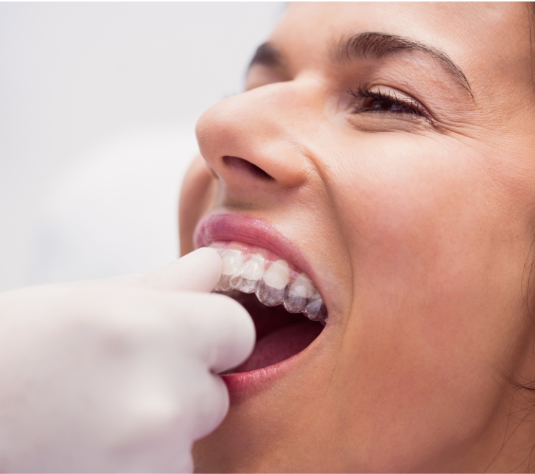 Invisalign consultation