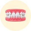 Invisalign treatment for underbite